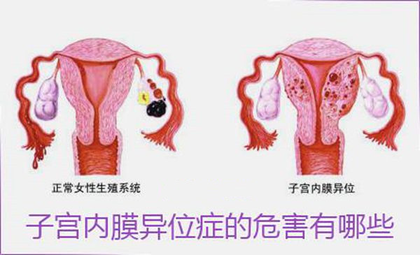 子宫内膜异位症有办法通过试管婴儿技术怀孕吗？