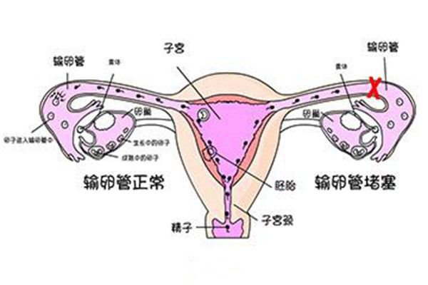 输卵管堵塞做试管婴儿怀孕