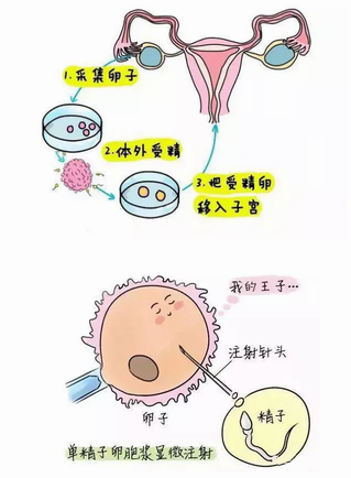 流产与宫外孕的区别多囊需要做试管婴儿