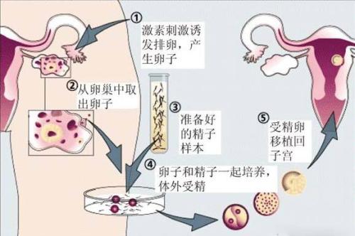 国家试管婴儿补助郑州出现六胞胎成功实施减胎手术保住俩