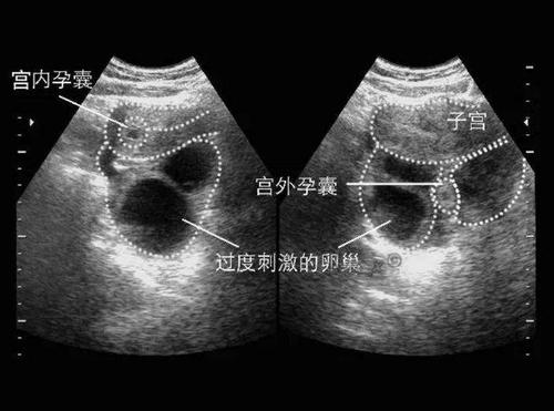 陕西首例宫外孕试管2pn胚胎3妈妈早产剖腹生女为男性孕育提供借鉴(图)