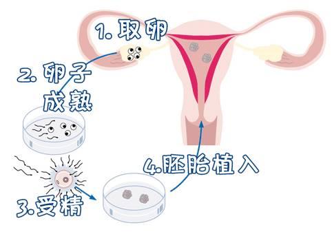 患了多囊卵巢综合征还能怀孕吗？试管拮抗剂作用四个技巧教你轻松备孕！