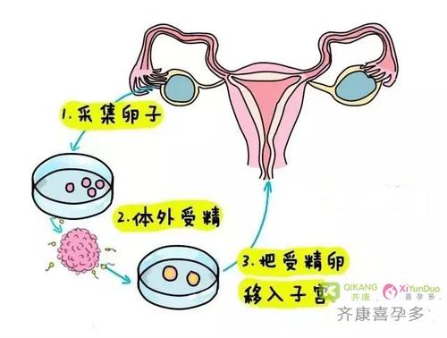 男生做试管婴儿2010中国妇科微创学术峰会在广州开幕