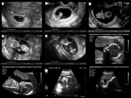 梦美生命：中美国试管婴儿的差异-表现在哪些地方试管一级胚胎胎停育？